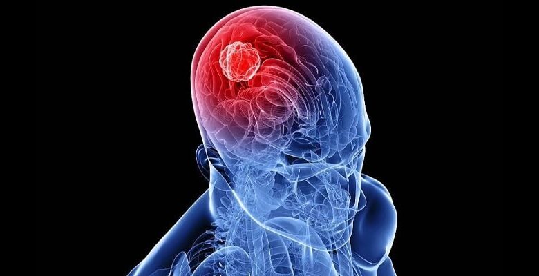  Beyin cerrahisi hangi hastalıklarda hayat kurtarıcı rol oynar?